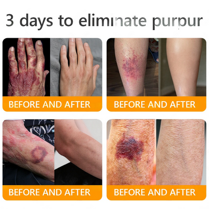 EQVP® 𝘽𝙀𝙀 𝙑𝙀𝙉𝙊𝙈 𝑺𝒌𝒊𝒏 𝑹𝒆𝒔𝒕𝒐𝒓𝒂𝒕𝒊𝒐𝒏 𝑪𝒓𝒆𝒂𝒎 –🐝 Anti-aging,Hydrating, Skin Repair, Even Tone, Acne and Dark Spot Treatment, Wart and Mole Removal, Psoriasis Relief